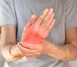 Rheumatoid Arthritis